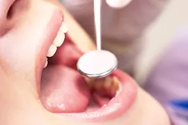 歯周病について