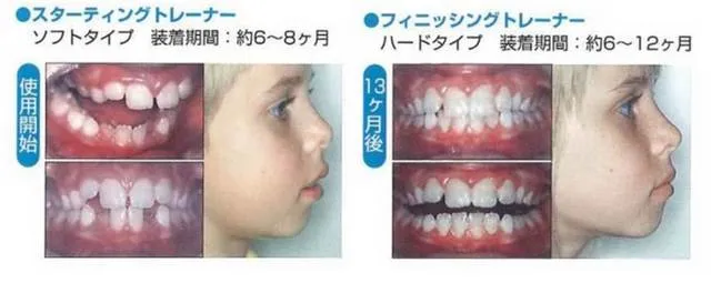 お子様の矯正について